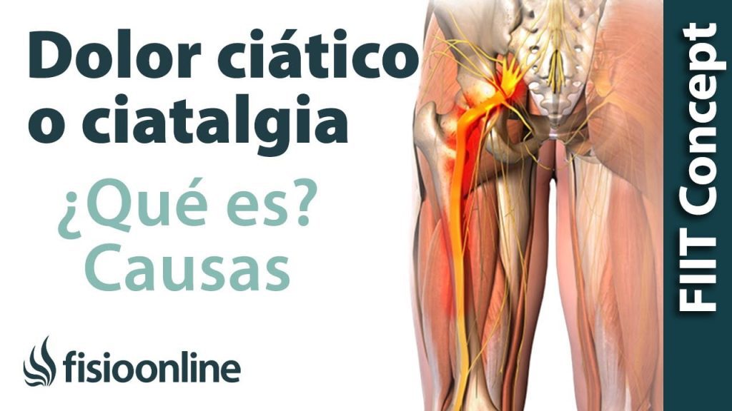 ¿Qué pierna afecta el nervio ciático? 1