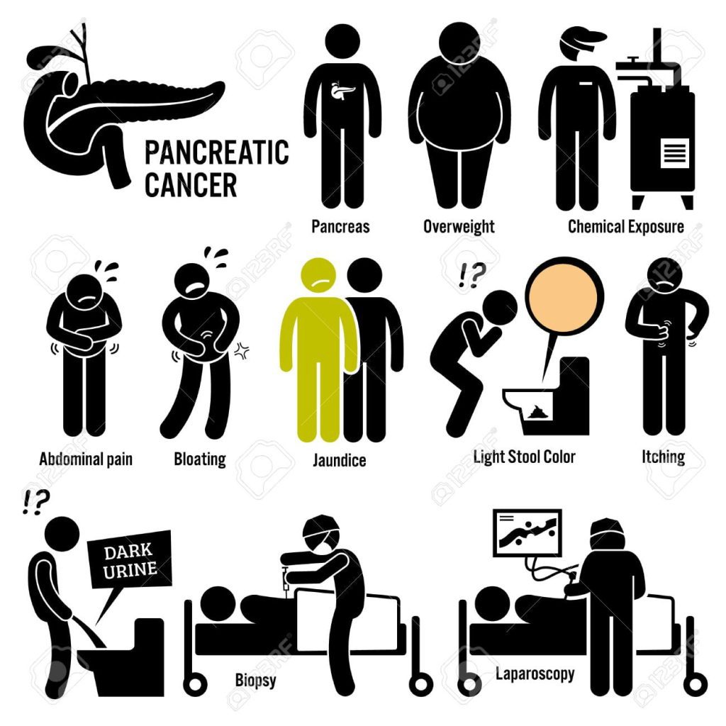 ¿Qué es lo que provoca el cáncer de páncreas? 6