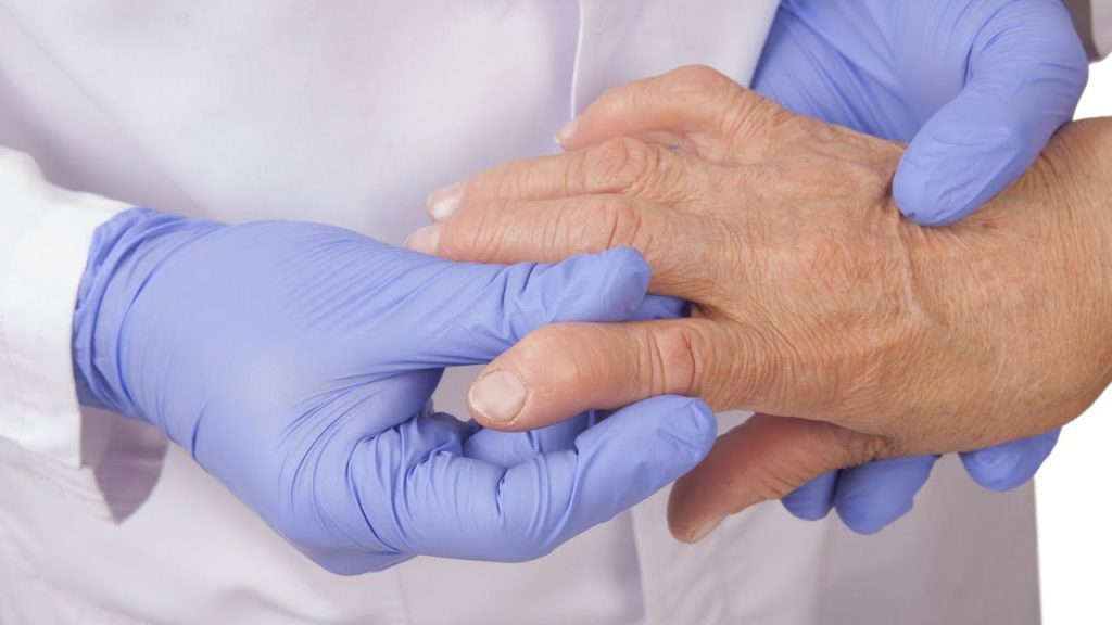 ¿Qué pasa si no se trata la artritis reumatoide? 4