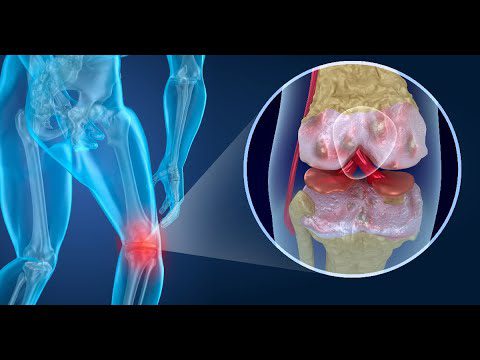 ¿Qué tomar para regenerar el cartílago de rodillas? 8